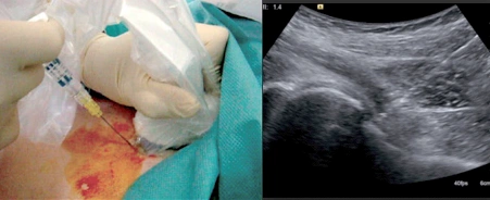 Artrite: trattamento e gestione con radiologia interventistica