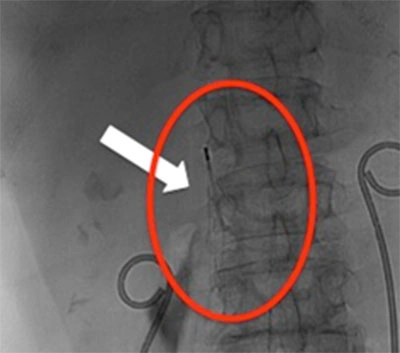 Filtro cavale Inserimento di un filtro cavale per prevenire emboli polmonari in pazienti con trombo.