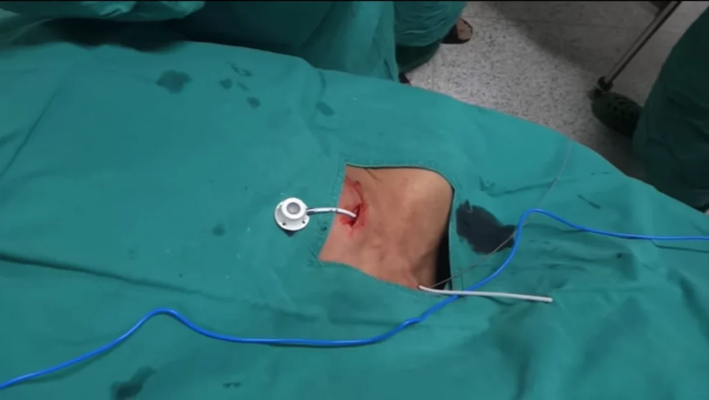 Accesso Venoso per il Posizionamento del Port-a-Cath. Medico che inserisce un catetere venoso centrale sotto guida ecografica.