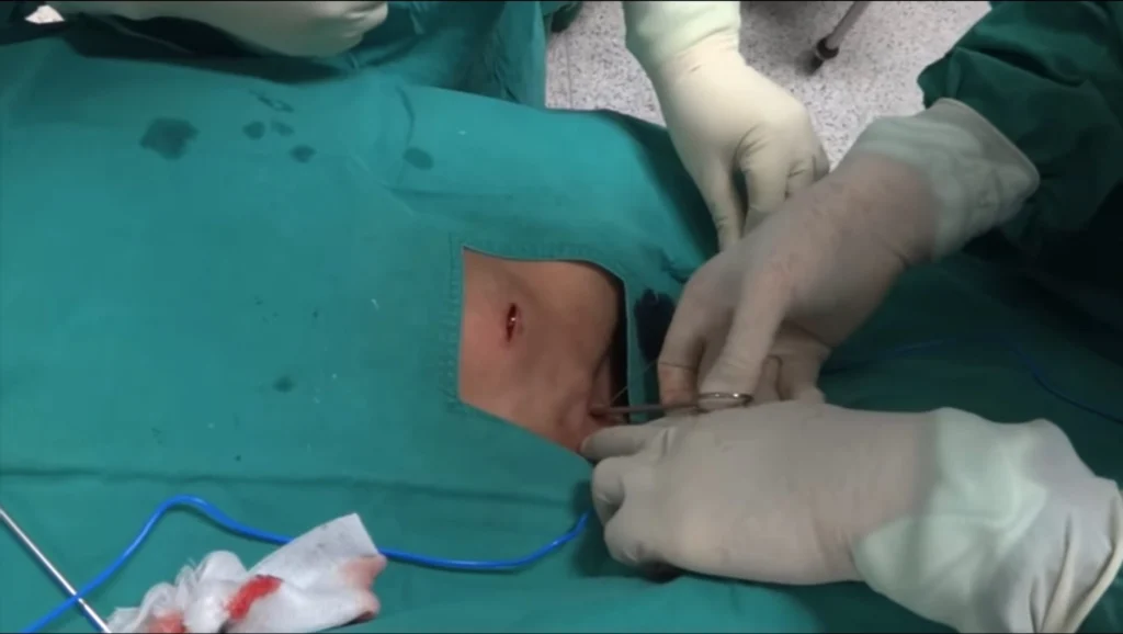 Creazione della Tasca Sottocutanea per il Port-a-Cath. Chirurgo che crea la tasca sottocutanea per il posizionamento della camera del Port-a-Cath.