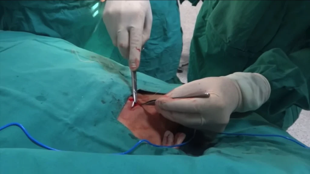 Collegamento del Catetere alla Camera del Port-a-Cath. Medico che collega il catetere alla camera del Port-a-Cath e verifica il corretto funzionamento.