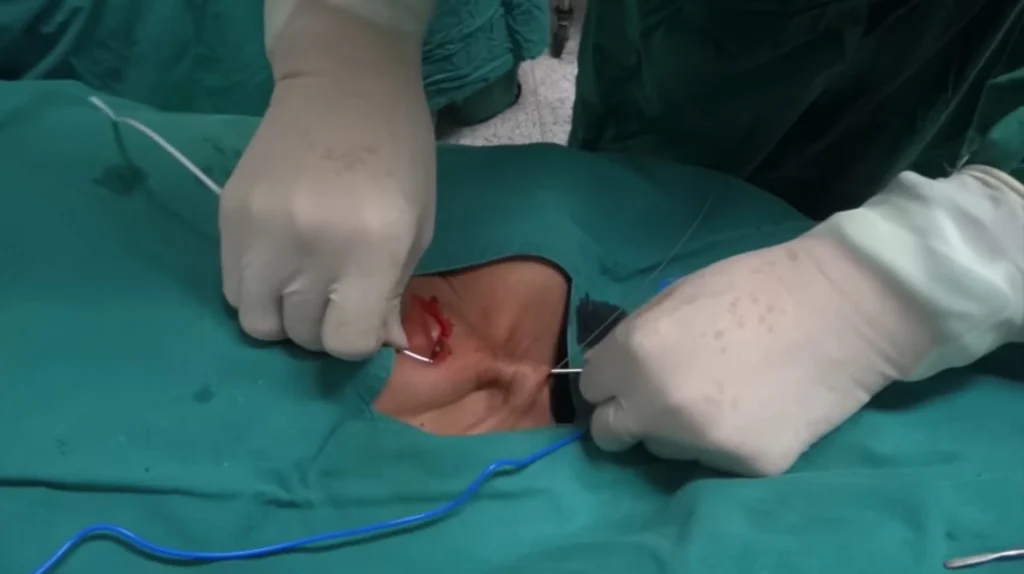 Sutura e Medicazione Dopo il Posizionamento del Port-a-Cath. Ferita suturata dopo l’impianto del Port-a-Cath con medicazione sterile.