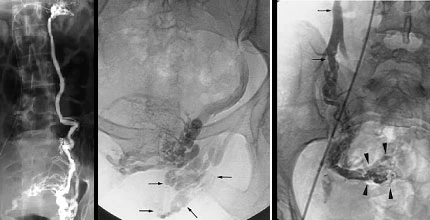Embolizzazione delle Vene Ovariche nella Radiologia Interventistica Embolizzazione delle vene ovariche per trattamento SCP