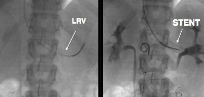 Embolizzazione delle Vene Pelviche nella Radiologia Interventistica Embolizzazione delle vene pelviche per trattamento SCP