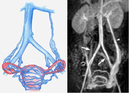 Catetere Endovascolare nella Radiologia Interventistica Introduzione catetere endovascolare per trattamento SCP