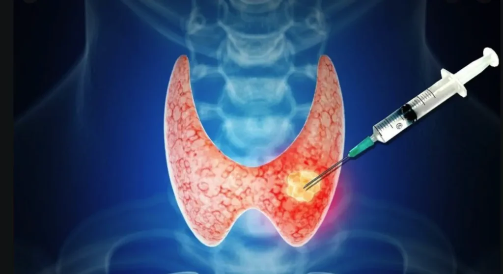 Procedura di ablazione con radiofrequenza per noduli tiroidei