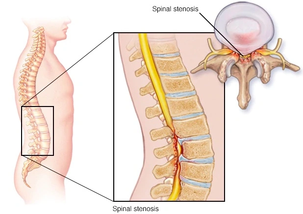 Posizione piegata in avanti per alleviare il dolore causato dalla stenosi lombare