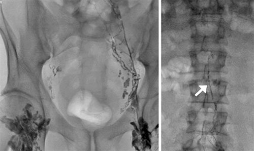 La linfografia è un esame fondamentale per valutare i leak linfatici e determinare la necessità di un'eventuale embolizzazione. Scopri come si esegue.