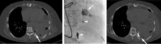 La puntura percutanea ed embolizzazione del leak linfatico è una tecnica minimamente invasiva per trattare le perdite linfatiche. Scopri come viene eseguita.
