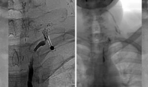 L'embolizzazione del leak linfatico toracico è una soluzione avanzata per trattare le perdite di linfa nel torace. Scopri i benefici di questa tecnica.