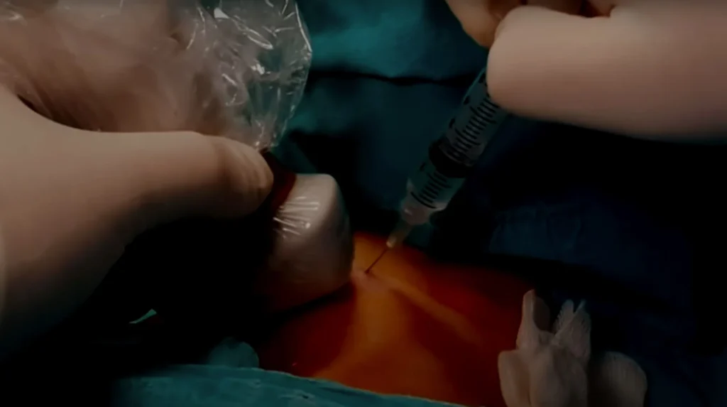 Ago eco-guidato per biopsia della tiroide