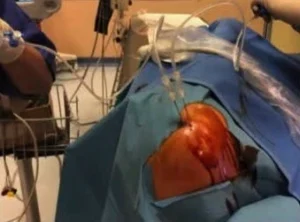 Posizionamento ago sotto guida ecografica durante litoclasia percutanea. Posizionamento del primo ago sotto guida ecografica per litoclasia percutanea