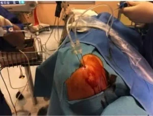 Posizionamento secondo ago per litoclasia percutanea sotto guida ecografica. Posizionamento del secondo ago sotto guida ecografica per il trattamento della calcificazione.