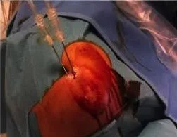 Sistema di lavaggio e aspirazione delle calcificazioni durante litoclasia percutanea. Sistema di lavaggio e aspirazione per rimuovere le calcificazioni nella litoclasia percutanea.