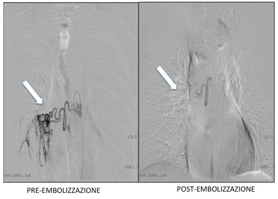 Embolizzazione Bronchiale: Trattamento Efficace del Sanguinamento Polmonare con Radiologia Interventistica Procedura di embolizzazione bronchiale per fermare il sanguinamento polmonare mediante radiologia interventistica