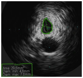 Trattamento endovascolare per Sindrome di May-Thurner Trattamento della Sindrome di May-Thurner con trombolisi e angioplastica sotto guida radiologica