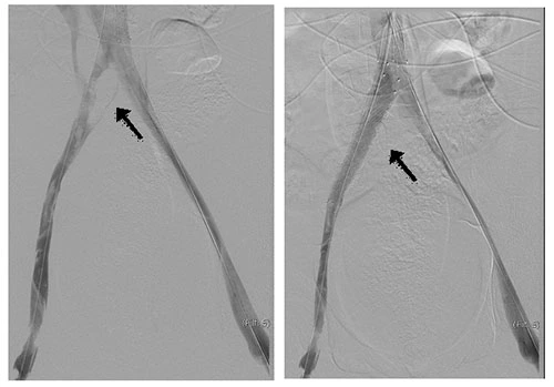 Posizionamento di stent per trattare la Sindrome di May-Thurner Posizionamento di stent per risolvere la compressione venosa nella Sindrome di May-Thurner