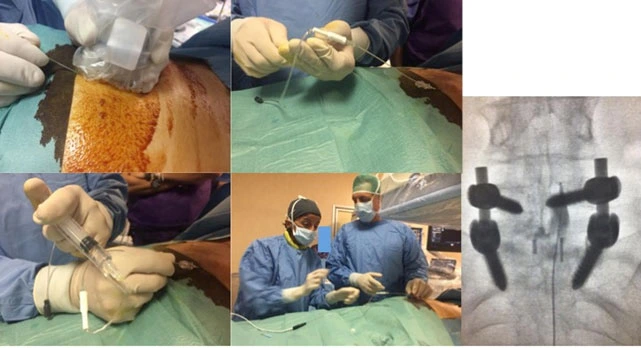 Anatomia della colonna lombare con stenosi, evidenziando la compressione delle radici nervose.