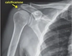 Somministrazione cortisone dopo trattamento di litoclasia percutanea Somministrazione di cortisone nella spalla dopo la litoclasia percutanea.