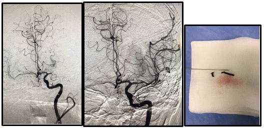 Angioplastica e stent per il trattamento dello stroke mmagine della radiologia interventistica per il trattamento dello stroke con angioplastica e stent.