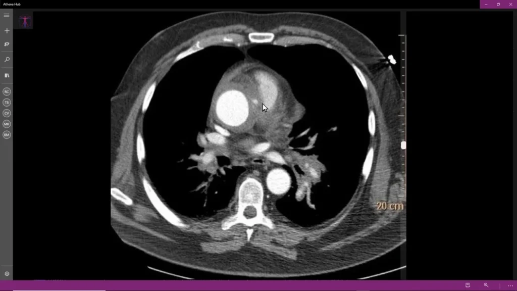 Trattamento endovascolare per ulcera penetrante dell'aorta con endoprotes