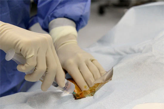 Anestesia locale per la puntura arteriosa durante l'arteriografia