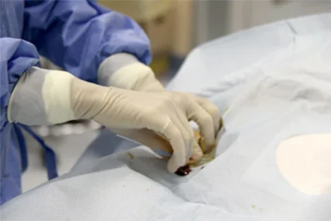 Puntura arteriosa effettuata con un ago appuntito per l'accesso vascolare.