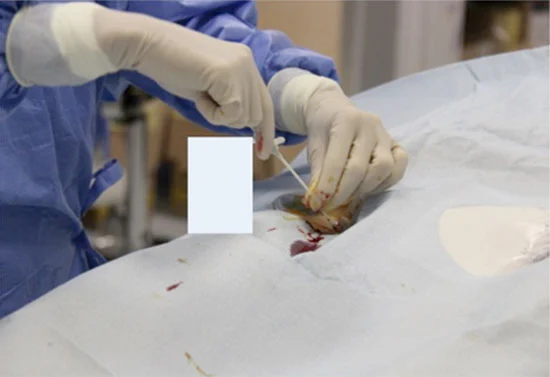 Introduzione dell'introduttore per il posizionamento del catetere durante l'arteriografia.