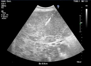 Biopsia percutanea in sala operatoria eseguita con guida tomografica computerizzata (TC) per un prelievo preciso