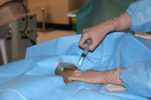 Dott.ssa Ierardi esegue la TACE in sala operatoria per il trattamento mirato dei tumor Dott.ssa Ierardi in sala operatoria durante la procedura TACE per trattamento tumorale