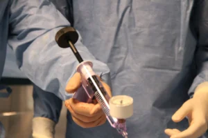 Prof. Carrafiello guida la procedura TACE per il trattamento dei tumori epatici. Prof. Carrafiello supervisiona la TACE in sala operatoria per il trattamento di tumori epatici.