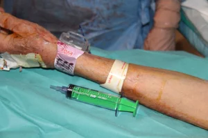 Catetere posizionato durante la TACE per il trattamento dei tumori epatici. Catetere inserito per la chemioembolizzazione trans-arteriosa (TACE) in sala operatoria.