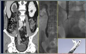 Biopsia Endoureterale: Prelievo di Tessuti dall'Uretere per Diagnosi Biopsia endoureterale tramite accesso ascendente per prelevare campioni dall'uretere alla vescica