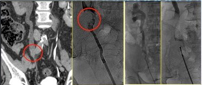 Biopsia Endoureterale: Prelievo di Tessuti da Uretere e Reni Biopsia endoureterale eseguita tramite approccio discendente per prelevare campioni dal rene e uretere