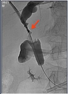 Biopsia Endobiliare: Prelievo di Tessuti dal Dotto Biliare Biopsia endobiliare tramite accesso percutaneo per il prelievo di tessuti dal dotto biliare