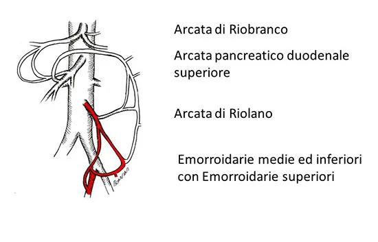 Coiling per trattamento di aneurisma viscerale, radiologia interventistica mini-invasiva