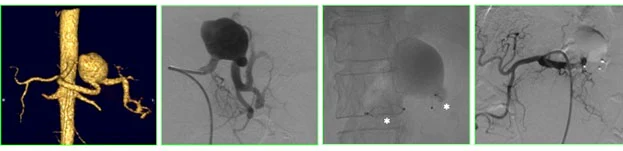 Esame TAC per diagnosi aneurisma viscerale