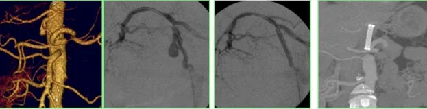 Esame eco-color-doppler per aneurisma viscerale