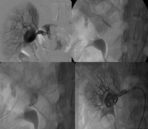 Trattamento chirurgico di aneurisma viscerale, intervento a cuore aperto