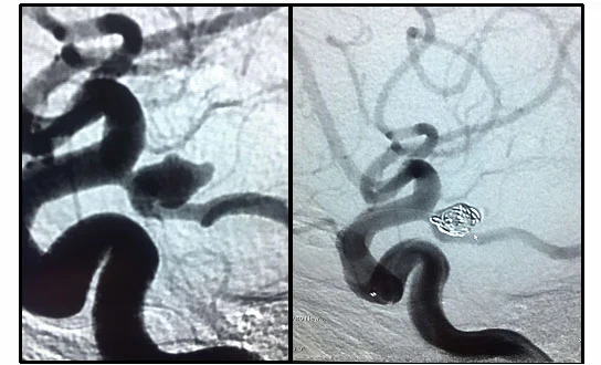 Embolizzazione aneurisma cerebrale con spirali in platino tramite intervento endovascolare