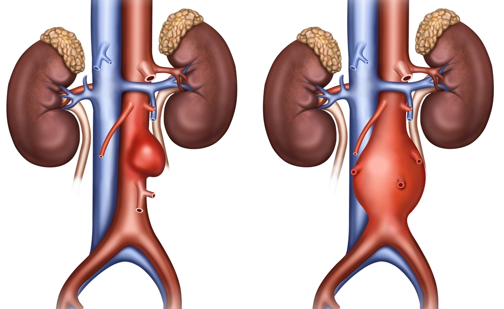 Trattamento endovascolare per aneurisma dell'aorta toracica con radiologia interventistica.