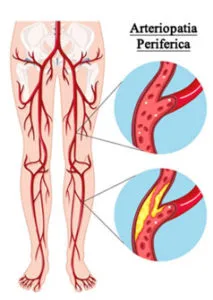 Arteriopatia Obliterante Periferica trattamento endovascolare radiologia interventistica