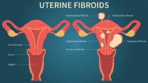 Tecniche avanzate di radiologia interventistica per fibromi uterini