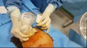 Diagnosi dei fibromi uterini tramite tecniche avanzate di imaging