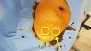 Tecniche ablative per trattare fibromi uterini