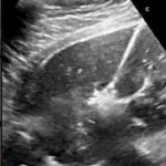 Miomectomia per la rimozione dei fibromi uterin