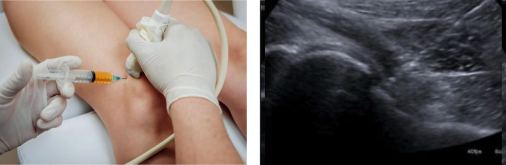 Infiltrazione intra-articolare per il trattamento dell'artrosi