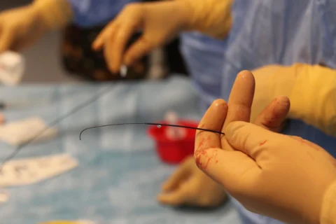 Medico che esegue un intervento di embolizzazione in sala operatoria con catetere inserito nel vaso sanguigno.