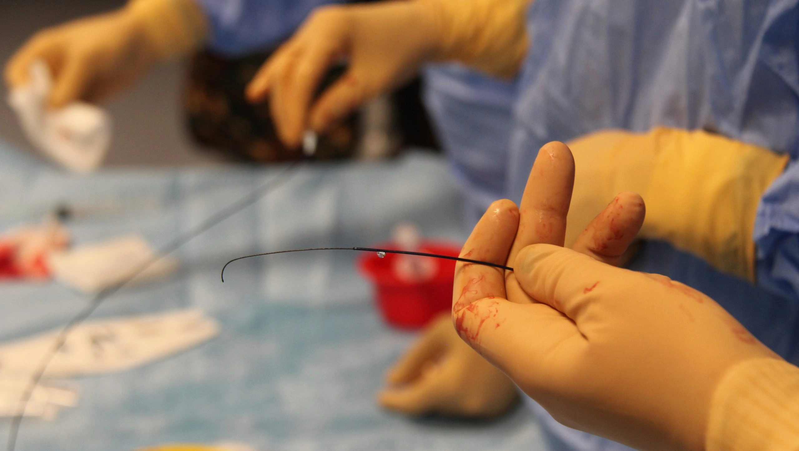 Medico che esegue un intervento di embolizzazione in sala operatoria con catetere inserito nel vaso sanguigno.