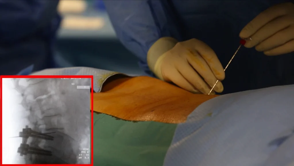 Decompressione meccanica durante la discectomia Dispositivo per decompressione meccanica del disco intervertebrale durante la discectomia percutanea.